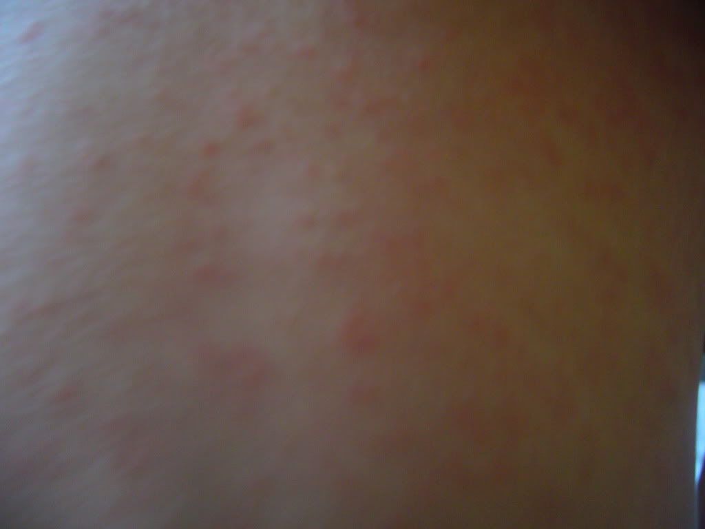 PICS ADDED.anyones lo"s get a rash after antibiotics? Baby, childrens